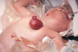 शरीर बाहिर मुटु भएकी शिशुको सफल सङ्घर्ष