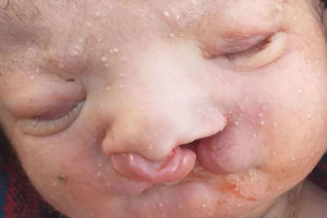 दैलेखमा नाक र मुख नछुट्टिएको बच्चा जन्मियो