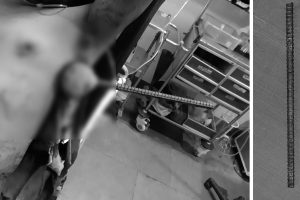 कोरोना संक्रमितको छातीमा गाडिएको १२ इन्चको रड निकालियो