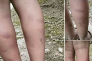 पाँचथरको सिंहदेवी विद्यालयमा अध्ययनरत बालकमाथि गृहकार्य नगरेको भन्दै कुटपिट